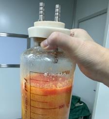 七台河水动力吸脂手术要做多久？
